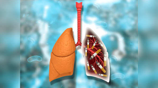 What causes lung cancer?