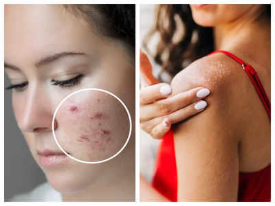 sunburn-sun tan-summer blisters-Carcinoma-Types of carcinoma-Dr Qaisar Ahmed-Best Homeopathic doctor-Al Haytham clinic-Risalpur-KPK-Pakistan