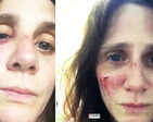These shocking pictures of French actress Judith Chemla’s bruised face leave her fans worried