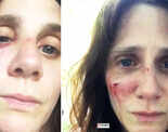 These shocking pictures of French actress Judith Chemla&rsquo;s bruised face leave her fans worried