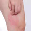 Skin chafing during monsoon: Tips to avoid chafing and how to recover ...