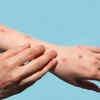Signs of monkeypox to watch out for