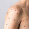 Those with underlying immune deficiencies may be at an increased risk of serious symptoms