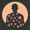 What is Monkeypox?