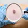 ​Melanoma cases in India