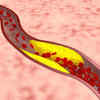 What is peripheral artery disease (PAD)?