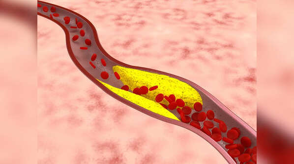 What is peripheral artery disease (PAD)?