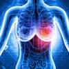 Identify the symptoms of breast cancer on time