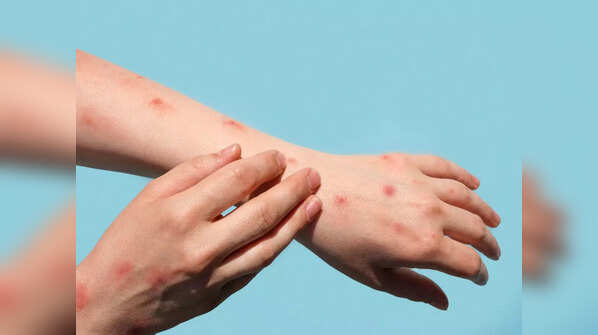 Monkeypox status in India
