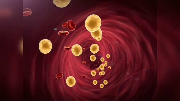 High cholesterol can cause other complications