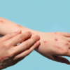 ​Monkeypox symptoms one should know