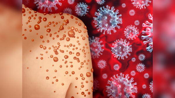 Homosexual men are spreading the disease