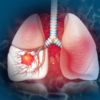 Article image for: Is diet responsible for <i class="tbold">lung cancer</i>?
