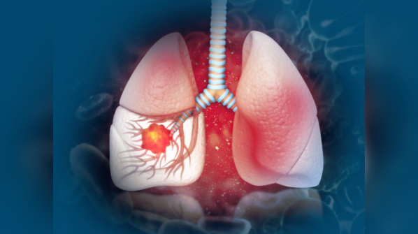Is diet responsible for lung cancer?