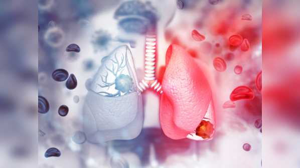 Who is at risk of having lung cancer?