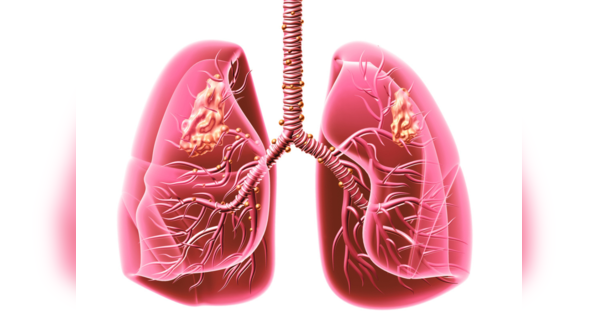What are the symptoms of lung cancer?