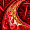 What is peripheral artery disease (PAD)?