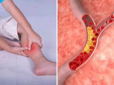 High cholesterol symptoms: THIS colour in your leg could indicate high  cholesterol | The Times of India