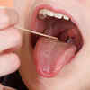 Swollen tonsils