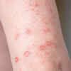 Solitary lesions