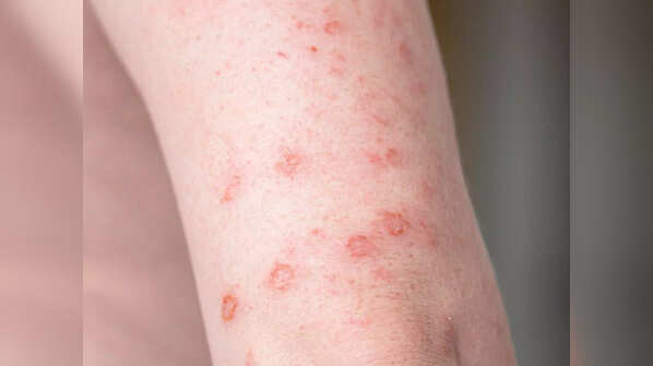 Solitary lesions