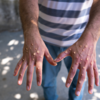 ​Monkeypox: The timeline of symptoms is crucial