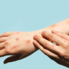​Monkeypox: Details of the symptoms seen in these patients