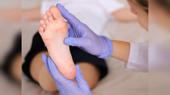 On treating lesions associated with monkeypox