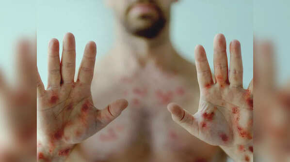 How to differentiate between Monkeypox and COVID