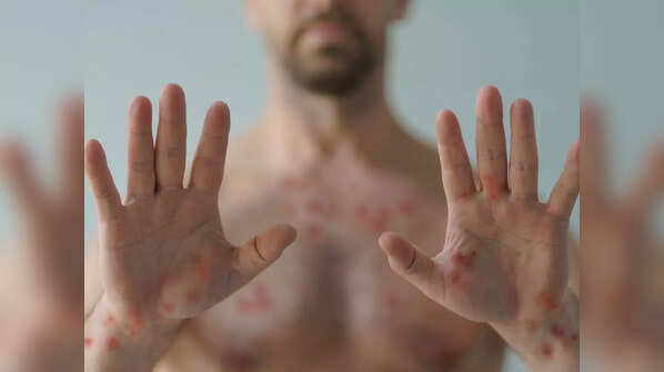Is monkeypox a sexually transmitted disease?