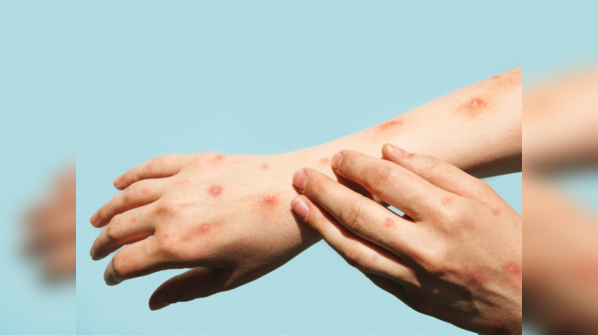 What are the symptoms of monkeypox?