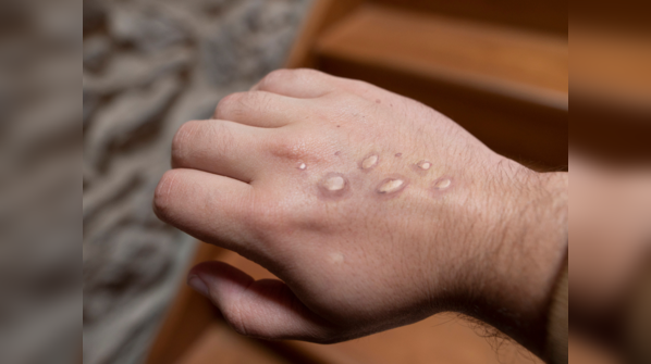 How is monkeypox transmitted?