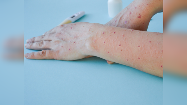 How to take care of monkeypox lesions?