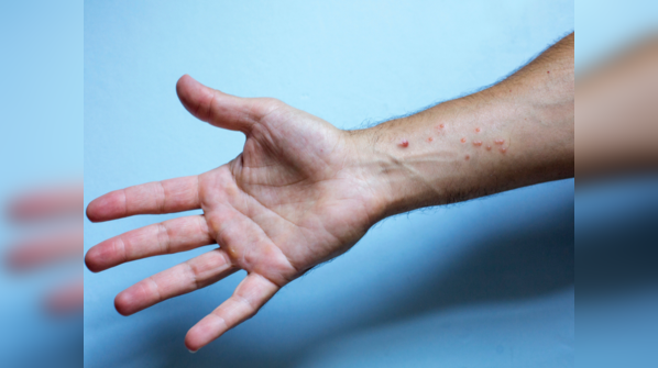 Distinctive features of monkeypox lesions