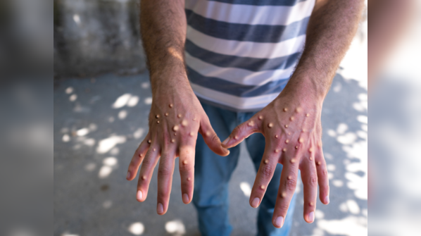 Monkeypox lesions are painful and itchy