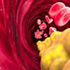 One warning sign of high cholesterol that may get missed