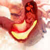 What is high cholesterol?