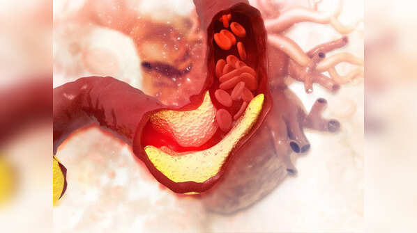 What is high cholesterol?