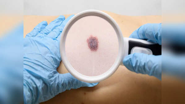 Types of skin cancer