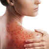 How to tell a monkeypox rash and chickenpox rash apart?