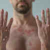 Monkeypox rash goes through several stages