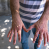 ​Global status of Monkeypox infection