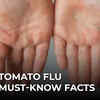Article image for: Tomato flu: What you must know about this new disease affecting children