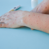 ​What is being asymptomatic?
