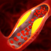 ​How to manage high blood cholesterol?