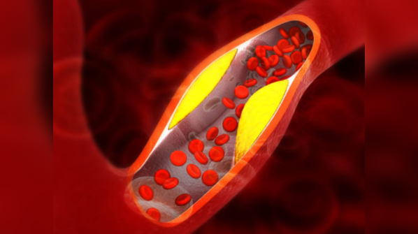 How to manage high blood cholesterol?