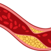 ​High cholesterol is the reason behind several life threatening diseases
