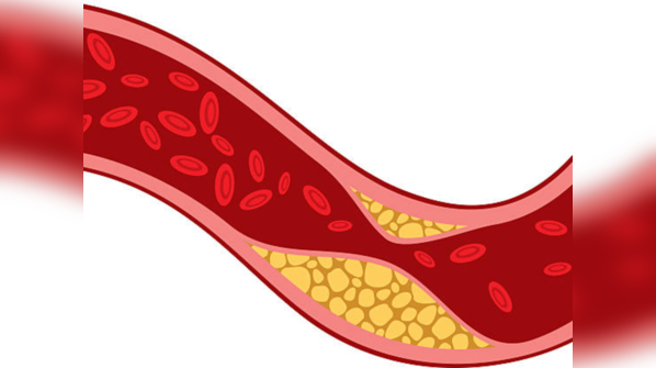 High cholesterol is the reason behind several life threatening diseases
