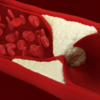 ​Family history of very high cholesterol levels is a determining factor