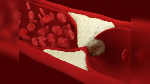 Family history of very high cholesterol levels is a determining factor